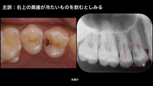 直接覆髄法 大きな虫歯でも神経を残す治療 福山市の歯医者 歯科 やまもと歯科 朝8時 診療